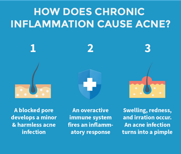 How chronic inflammation causes acne - a blocked pore becomes infected and triggers an inflammatory response, which creates swelling, redness, and irritation
