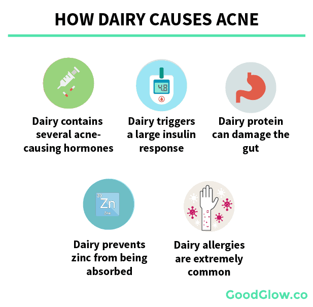 How dairy causes acne by increasing levels of acne-causing hormones, damages the gut, and prevents nutrient absorption