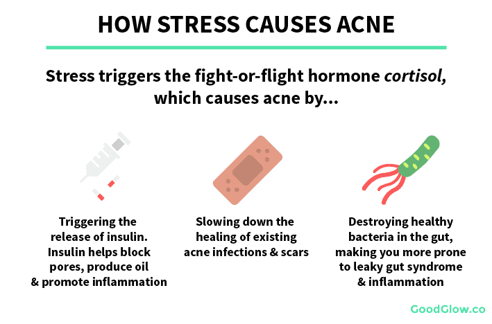 Stress triggers the release of insulin, slows down wound healing, and destroys gut bacteria that help prevent acne