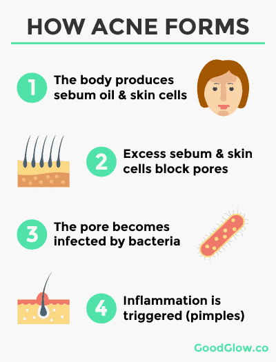 Acne is created when a pore becomes blocked or clogged due to excess sebum oil or dead skin cells. Acne bacteria then infects the blocked pore. An inflammatory response is triggered, and the infected pore becomes a pimple.
