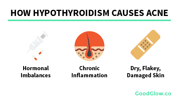 Hypothyroidism causes acne by creating hormonal imbalances, inflammation, and dry, flaky, acne-prone skin