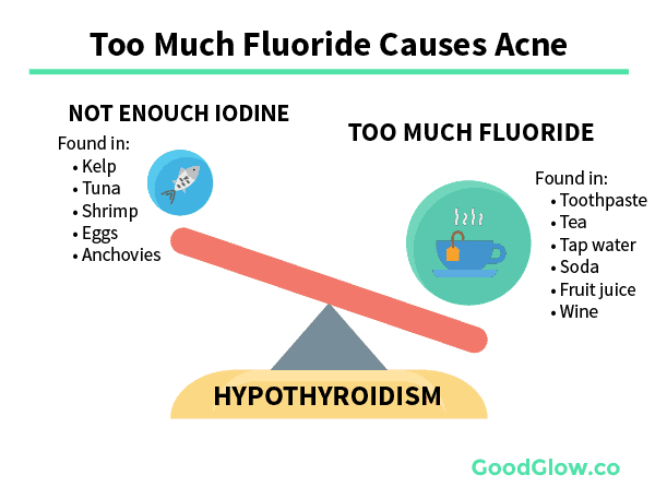 Too much fluoride causes acne by decreasing thyroid function