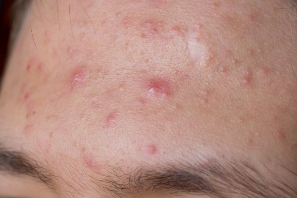Does Accutane Work for Fungal Acne - Good Glow