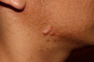 How to Treat Hypertrophic Scars - Good Glow