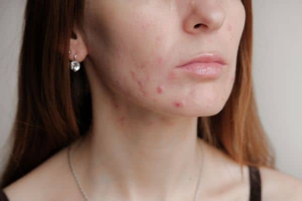 Natural Treatments for Cystic Acne in Adults - Good Glow