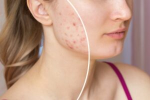 The 8 Types of Acne - And How To Treat Them