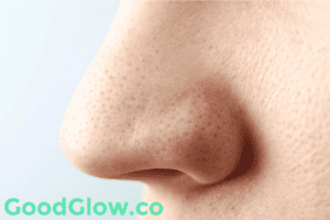 Does Waxing Remove Blackheads?