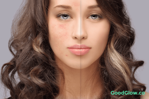 healed acne scars