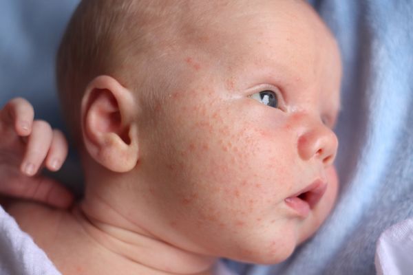Home Remedies for Baby Acne - Good Glow