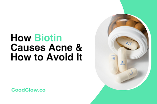 How Biotin Causes Acne & How to Avoid It - Good Glow