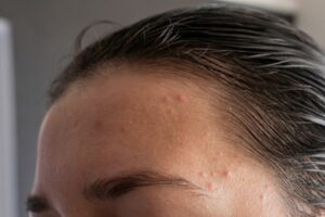 How to Treat Forehead Acne - Good Glow
